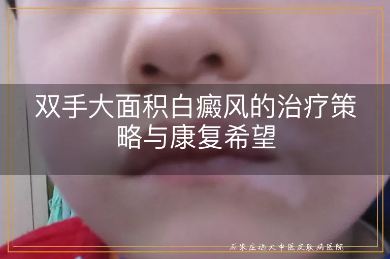 双手大面积白癜风的治疗策略与康复希望