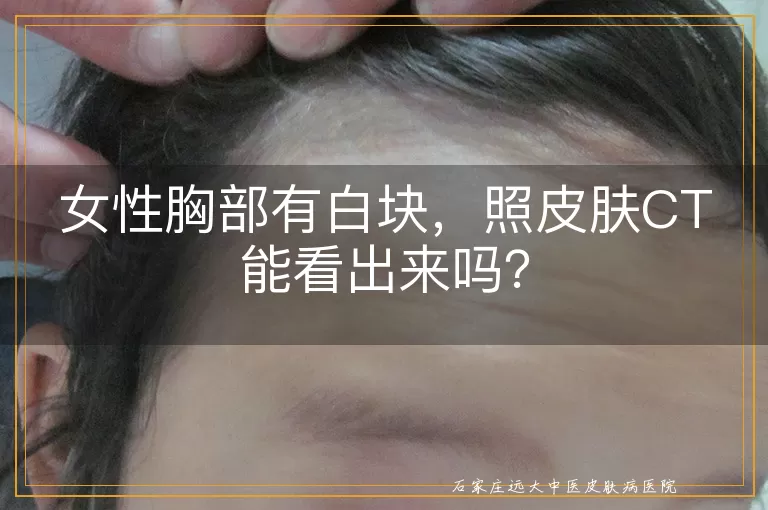 女性胸部有白块，照皮肤CT能看出来吗？