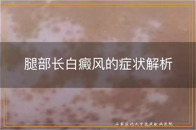 腿部长白癜风的症状解析