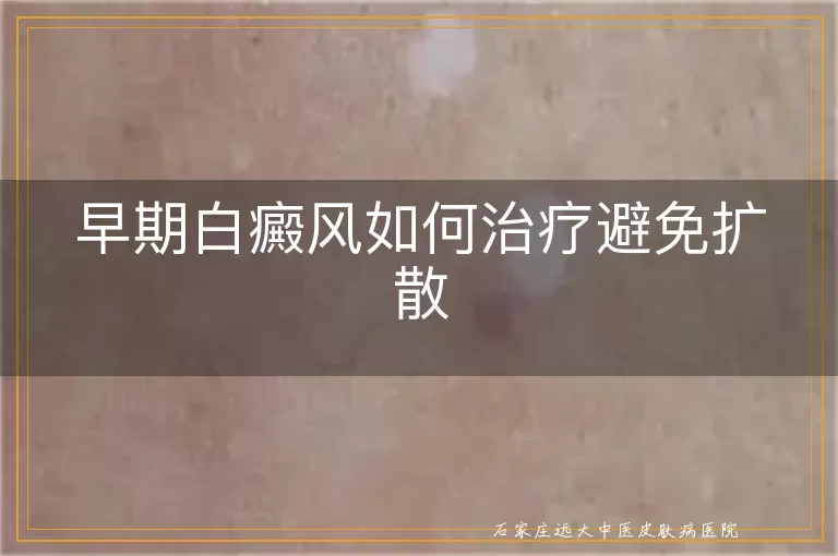 早期白癜风如何治疗避免扩散