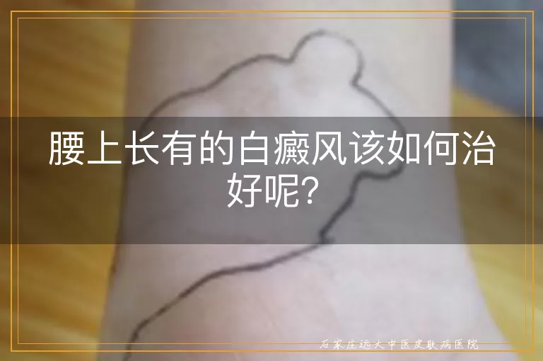 腰上长有的白癜风该如何治好呢？