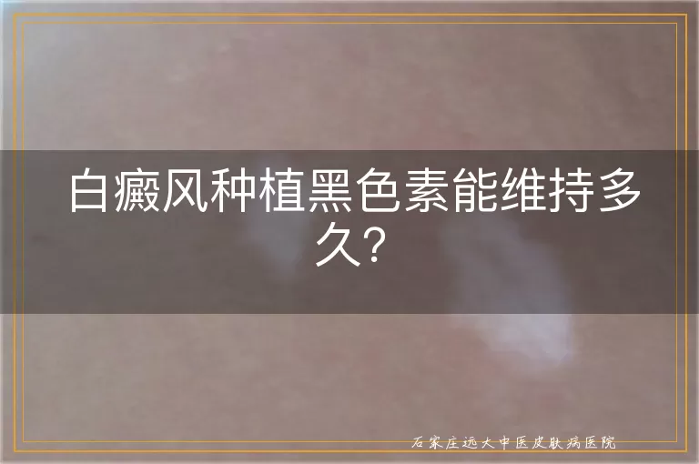 白癜风种植黑色素能维持多久？