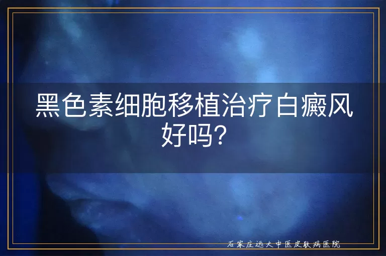 黑色素细胞移植治疗白癜风好吗？