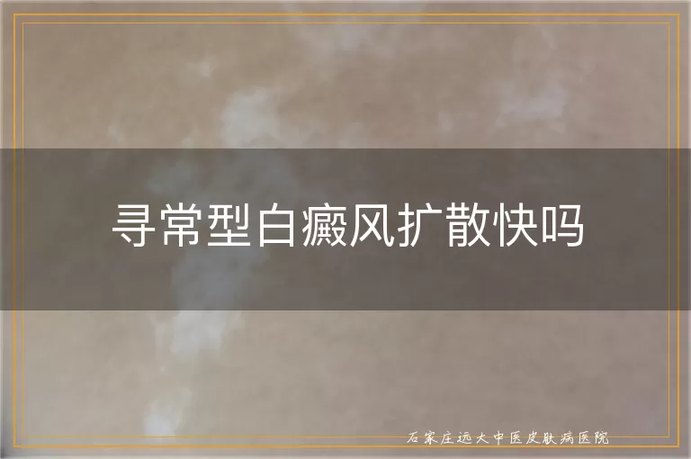 寻常型白癜风扩散快吗