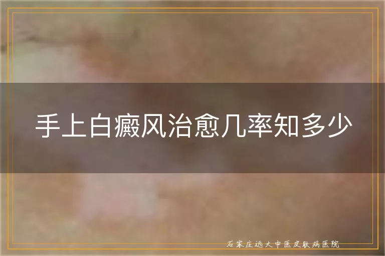 手上白癜风治愈几率知多少