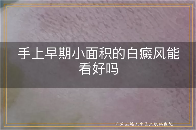 手上早期小面积的白癜风能看好吗