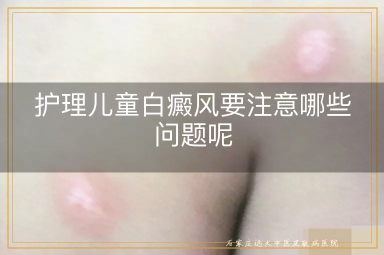 护理儿童白癜风要注意哪些问题呢