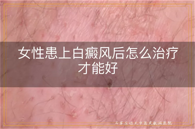 女性患上白癜风后怎么治疗才能好