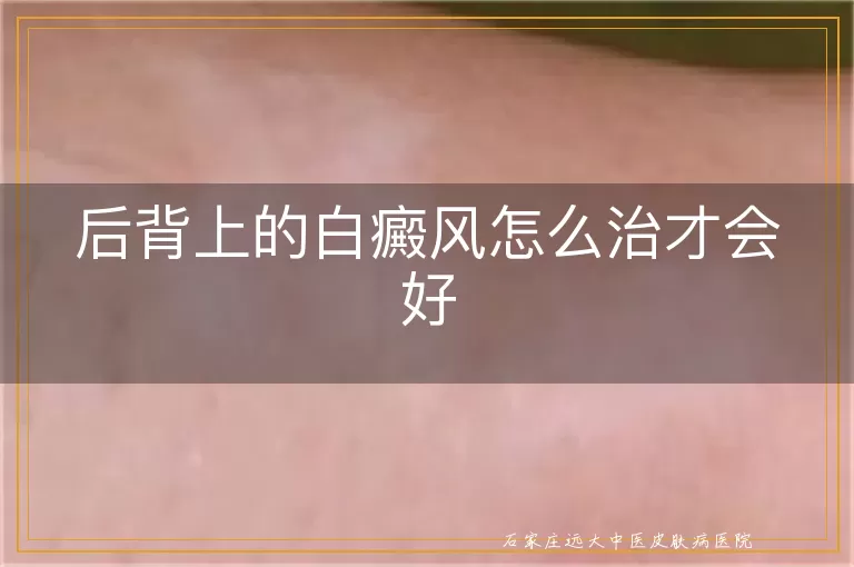 后背上的白癜风怎么治才会好