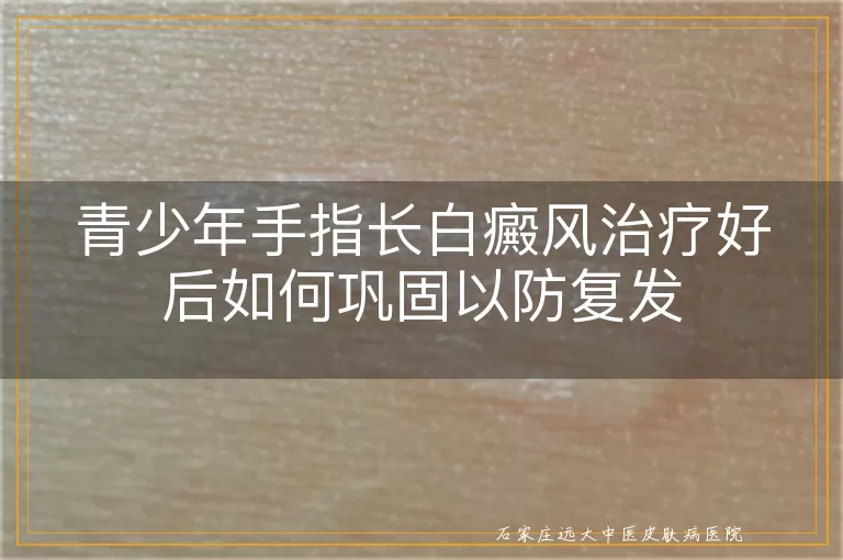 青少年手指长白癜风治疗好后如何巩固以防复发