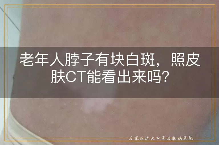 老年人脖子有块白斑，照皮肤CT能看出来吗？