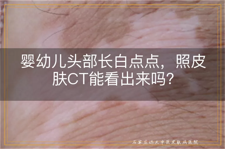 婴幼儿头部长白点点，照皮肤CT能看出来吗？
