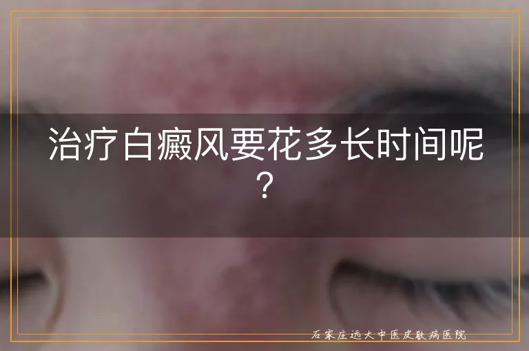 治疗白癜风要花多长时间呢？