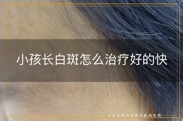 小孩长白斑怎么治疗好的快