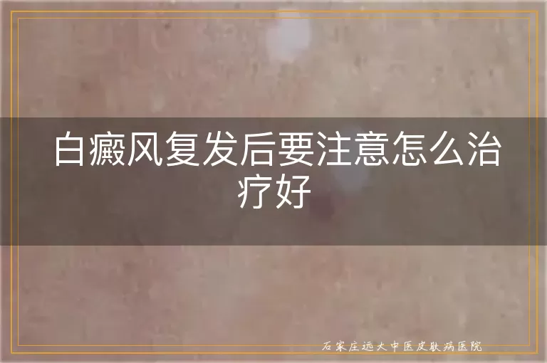 白癜风复发后要注意怎么治疗好
