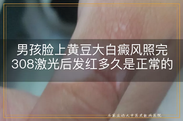 男孩脸上黄豆大白癜风照完308激光后发红多久是正常的？