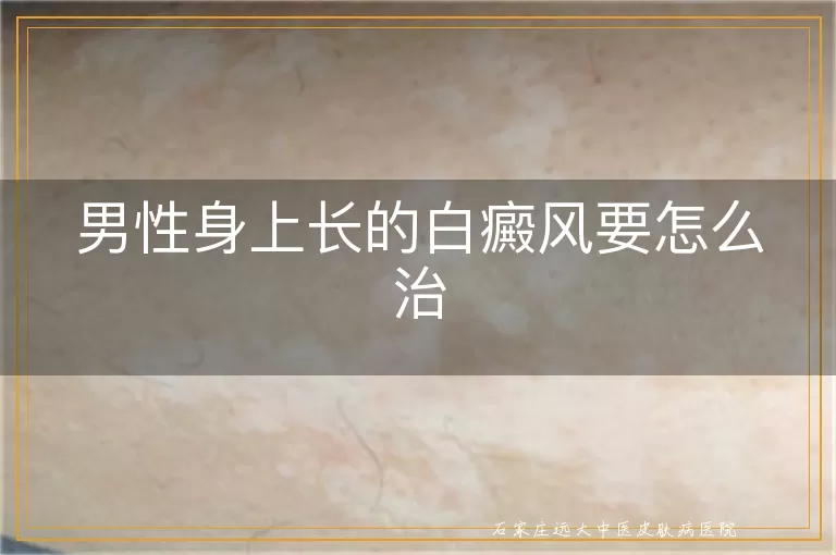 男性身上长的白癜风要怎么治