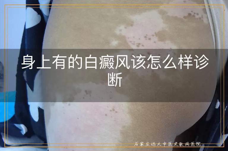 身上有的白癜风该怎么样诊断