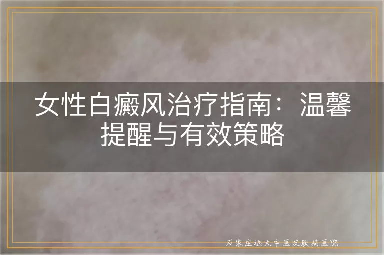女性白癜风治疗指南：温馨提醒与有效策略