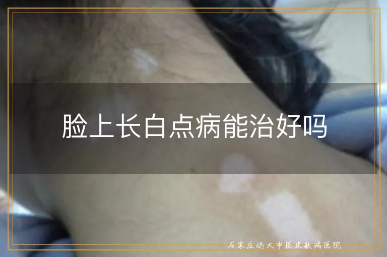 脸上长白点病能治好吗