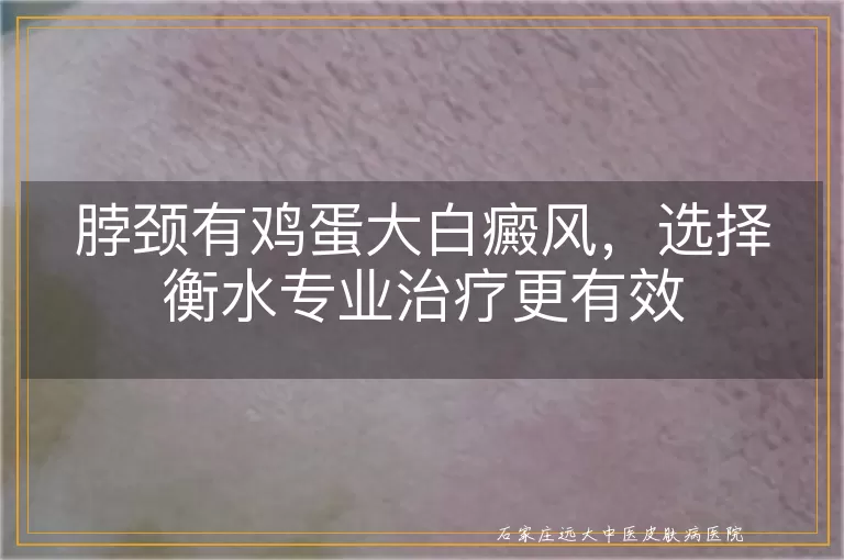 脖颈有鸡蛋大白癜风，选择衡水专业治疗更有效