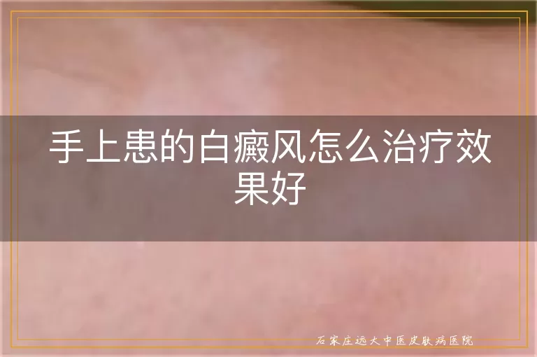 手上患的白癜风怎么治疗效果好
