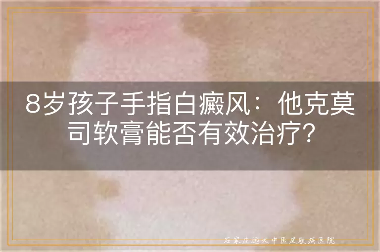 8岁孩子手指白癜风：他克莫司软膏能否有效治疗？