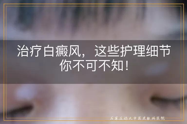 治疗白癜风，这些护理细节你不可不知！
