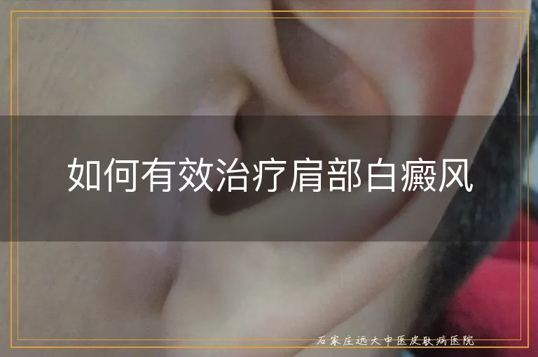 如何有效治疗肩部白癜风