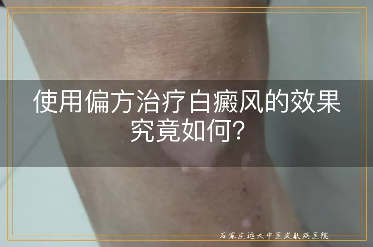 使用偏方治疗白癜风的效果究竟如何？