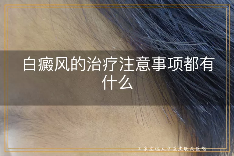 白癜风的治疗注意事项都有什么