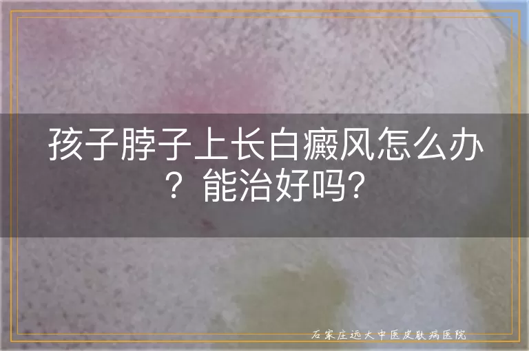 孩子脖子上长白癜风怎么办？能治好吗？