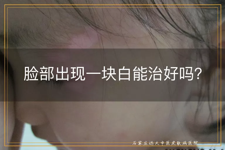 脸部出现一块白能治好吗？