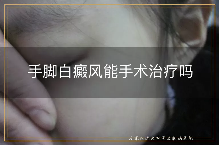 手脚白癜风能手术治疗吗