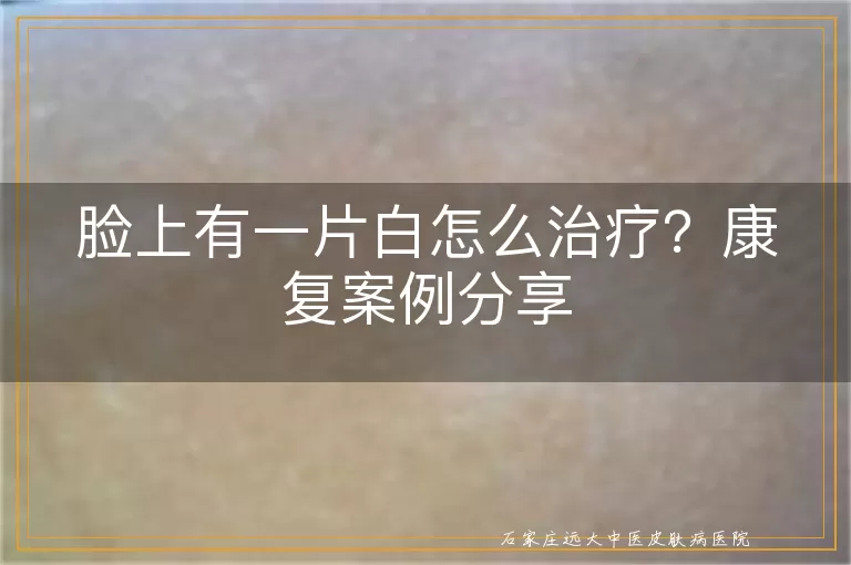 脸上有一片白怎么治疗？康复案例分享