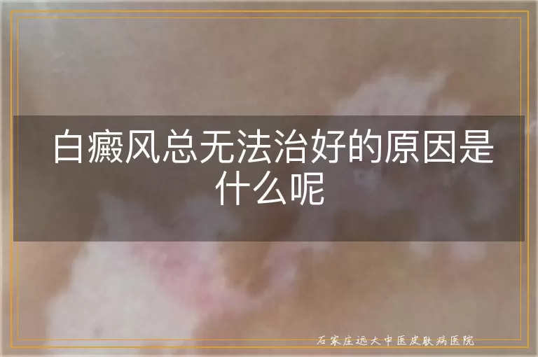 白癜风总无法治好的原因是什么呢