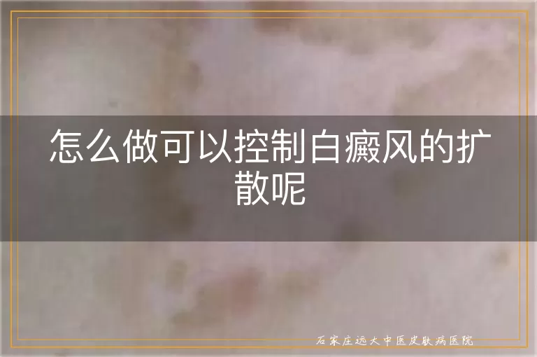 怎么做可以控制白癜风的扩散呢