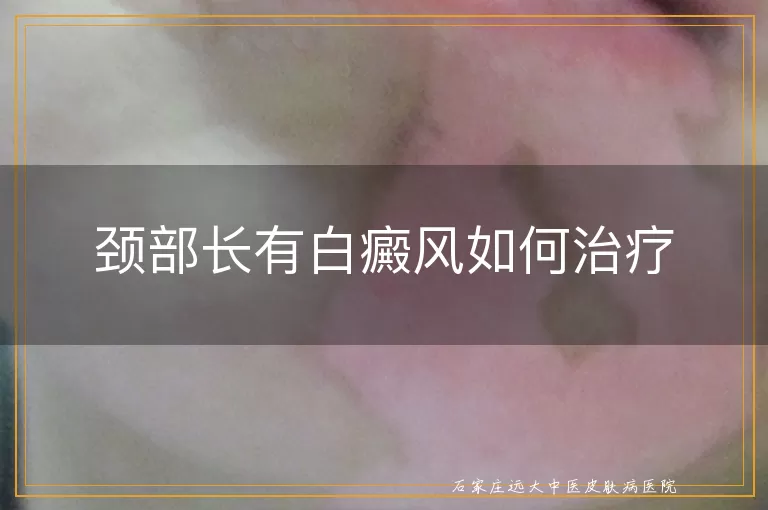 颈部长有白癜风如何治疗