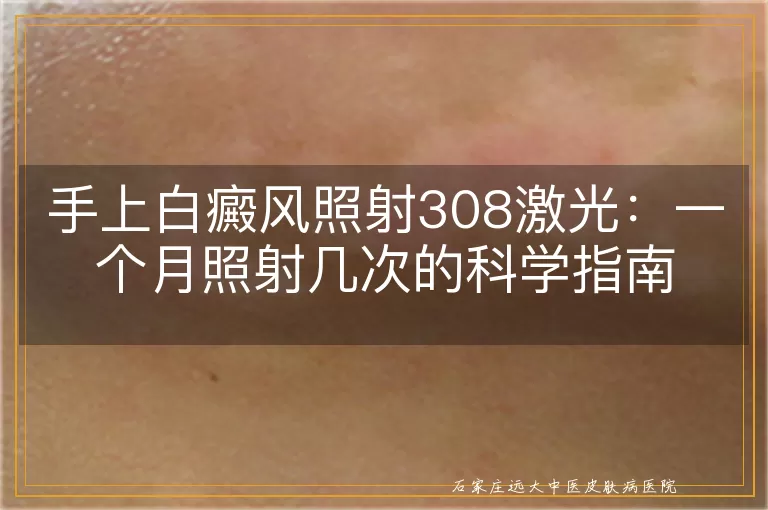 手上白癜风照射308激光：一个月照射几次的科学指南