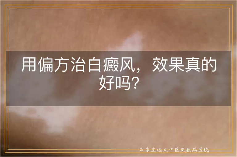 用偏方治白癜风，效果真的好吗？