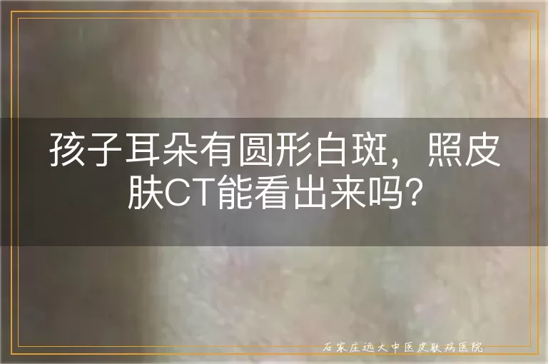 孩子耳朵有圆形白斑，照皮肤CT能看出来吗？