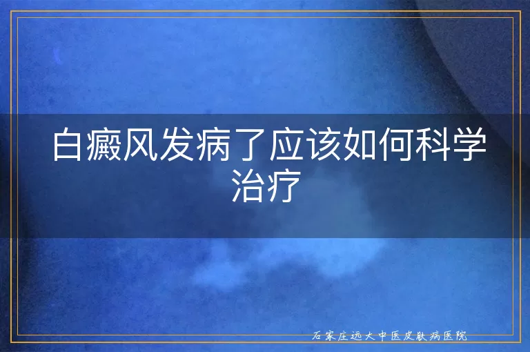 白癜风发病了应该如何科学治疗