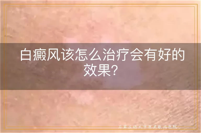 白癜风该怎么治疗会有好的效果？