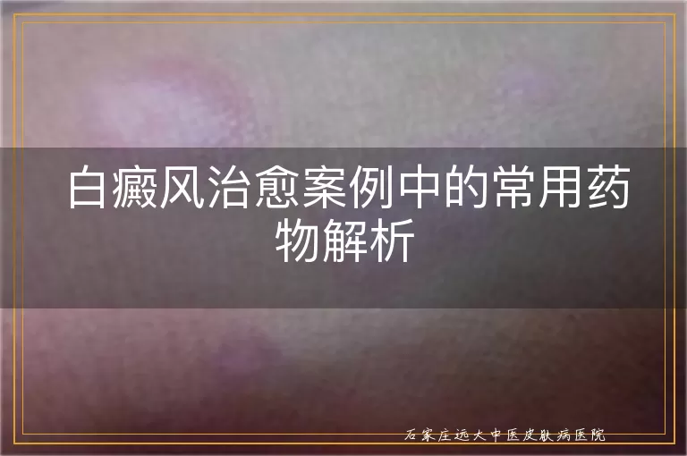 白癜风治愈案例中的常用药物解析
