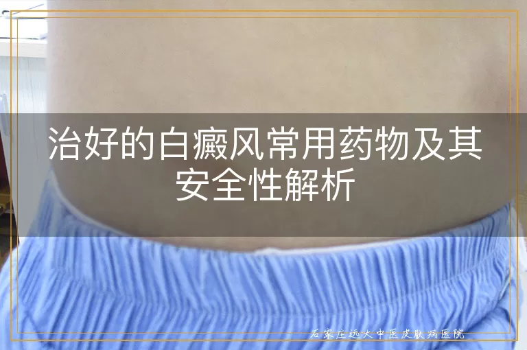 治好的白癜风常用药物及其安全性解析
