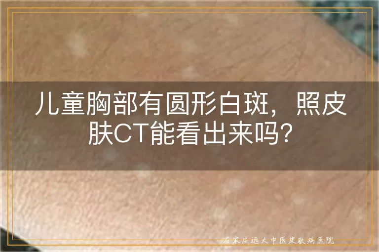 儿童胸部有圆形白斑，照皮肤CT能看出来吗？