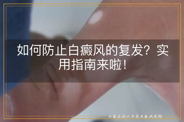 如何防止白癜风的复发？实用指南来啦！
