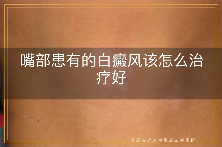 嘴部患有的白癜风该怎么治疗好