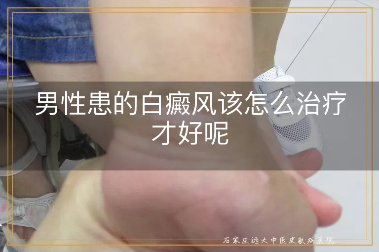 男性患的白癜风该怎么治疗才好呢