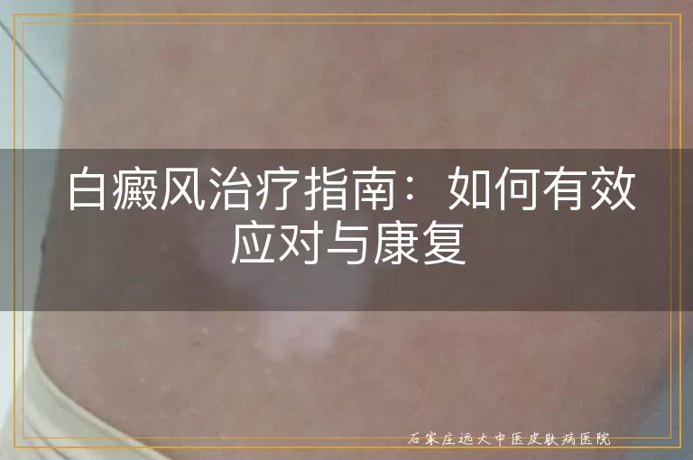 白癜风治疗指南：如何有效应对与康复